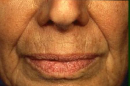 Before Case #81591 - Chemical Peel / Facelift