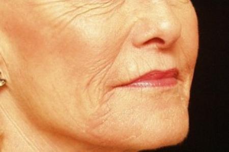 Before Case #81756 - Skin Resurfacing