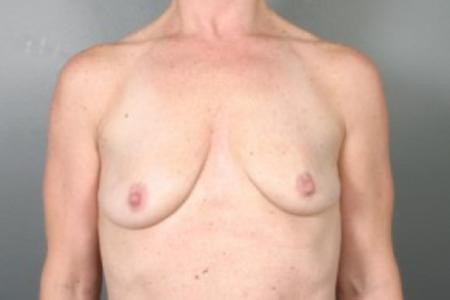 Before image 1 Case #83241 - Breast Lift/Augmentation with Shaped Silicone Implants