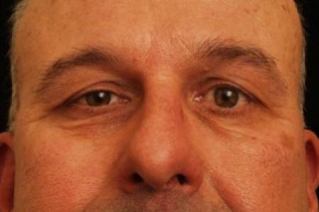 Before image 1 Case #81731 - Eyelid Surgery
