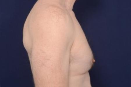 Before image 3 Case #87516 - Gynecomastia