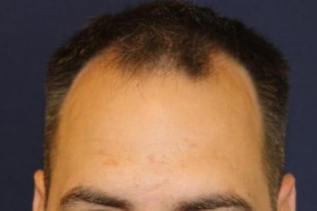 Before image 1 Case #87376 - Hair Transplantation San Diego