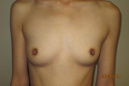 Before image 1 Case #82431 - 25 Female Breast Augmentation