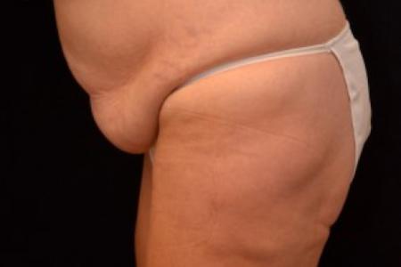 Before image 2 Case #81721 - Tummy Tuck
