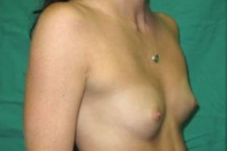 Before image 2 Case #85791 - Breast Augmentation 