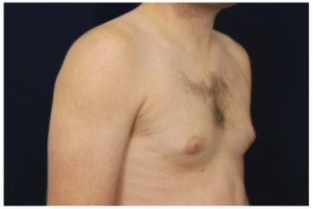 Before image 2 Case #86916 - Gynecomastia