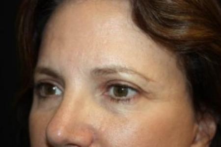 Before image 2 Case #84271 - Brow Lift- 60 year old female