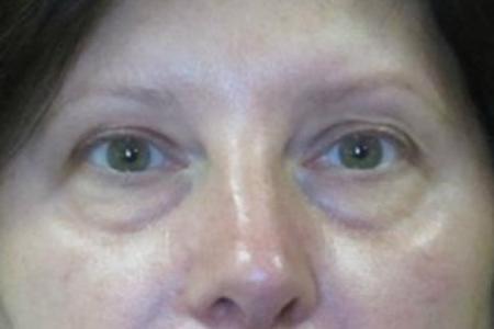 Before image 1 Case #82616 - Upper and lower eyelids