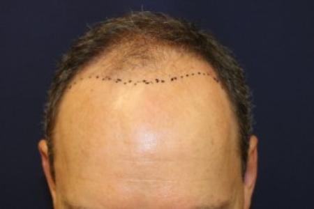 Before Case #87381 - Hair Transplantation San Diego