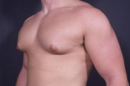 Before image 2 Case #84181 - Gynecomastia