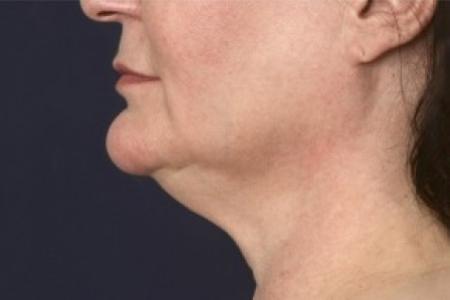 Before image 3 Case #87041 - Lower Facial Rejuvenation 