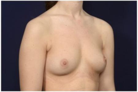 Before image 2 Case #86226 - 24 year old woman treated with Breast Augmentation