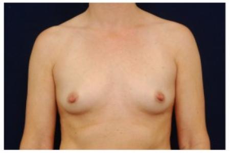 Before image 1 Case #87031 - Breast Augmentation
