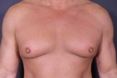Before image 1 Case #85246 - Bilateral Nipple Reduction