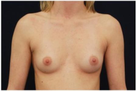 Before image 1 Case #81966 - Breast Augmentation