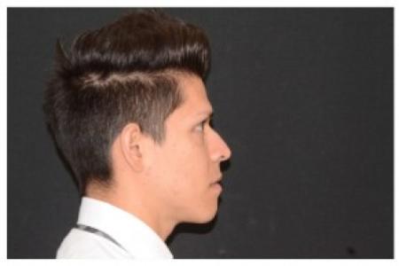 Before image 3 Case #87106 - Non-Surgical Rhinoplasty