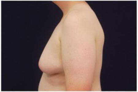 Before image 3 Case #82071 - Gynecomastia