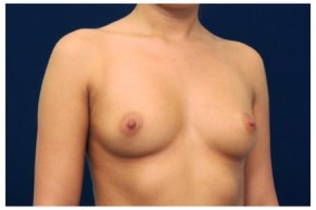 Before image 2 Case #81986 - Breast Augmentation