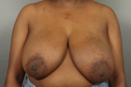 Before image 1 Case #83371 - Breast Reduction