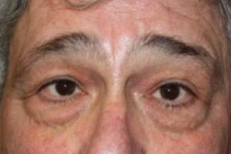 Before image 1 Case #84216 - Blepharoplasty - 61 year old male