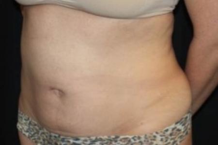 Before image 2 Case #85836 - Abdominoplasty - 39 year old female