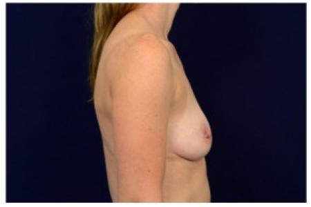 Before image 3 Case #87011 - Breast Augmentation