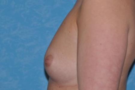 Before image 3 Case #83961 - Breast Augmentation Before and After