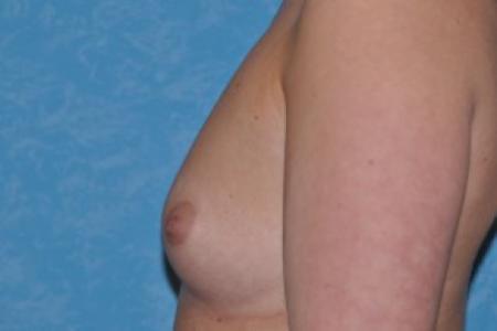 Before image 3 Case #83961 - Breast Augmentation Before and After