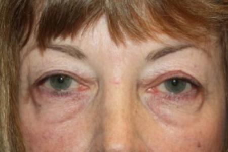Before image 1 Case #84711 - Blepharoplasty - 59 year old female.