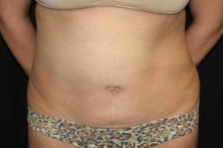 Before image 1 Case #85836 - Abdominoplasty - 39 year old female