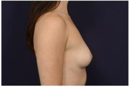 Before image 3 Case #86886 - Breast Augmentation
