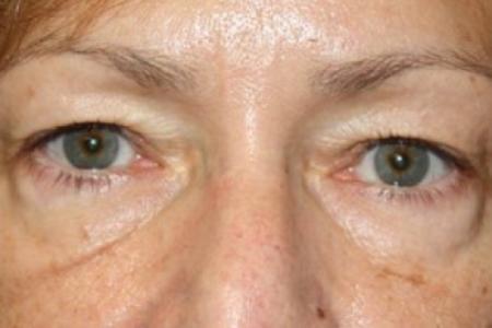 Before image 1 Case #83456 - Blepharoplasty - 57 year old female.