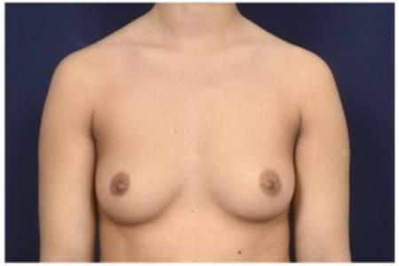 Before image 1 Case #86241 - 28 year old woman treated with Breast Augmentation