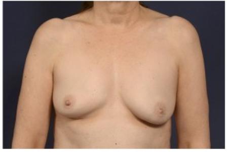 Before image 1 Case #84761 - Fat Grafting of Breasts