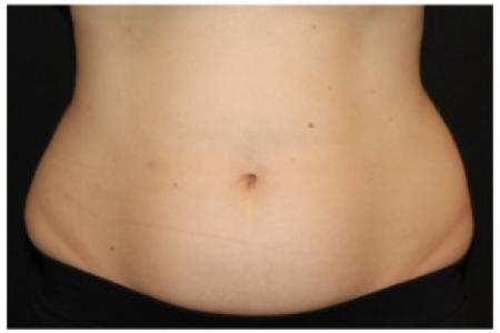 Before image 1 Case #86351 - 37 year old woman treated with nonsurgical fat reduction.