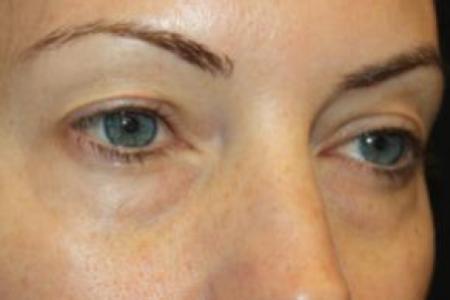 Before image 2 Case #85846 - Blepharoplasty - Upper and Lower Lids - 42 year old female