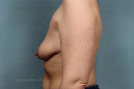 Before image 3 Case #88166 - Breast Lift with Implants