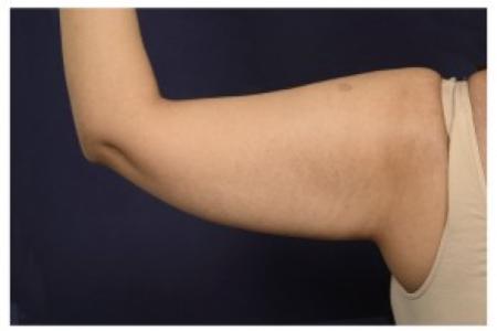 Before image 2 Case #87066 - Upper Arm Lift
