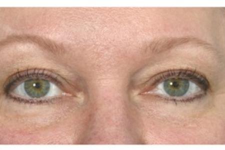Before image 1 Case #87121 - Eye Area Rejuvenation