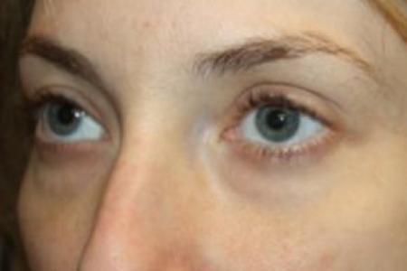 Before image 2 Case #85876 - Blepharoplasty - Lower Lids Only - 34 year old female