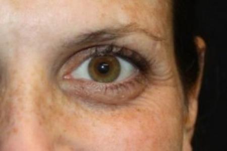 Before image 1 Case #83891 - Botox (Crows Feet Only) - 34 year old female.