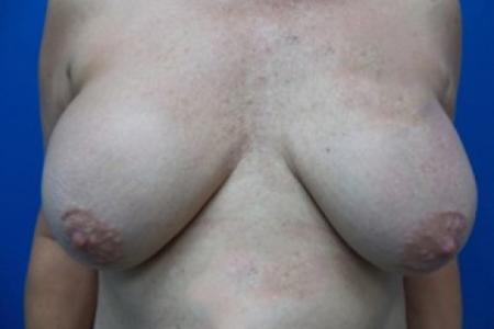 Before image 1 Case #87291 - Breast Augmentation Revision with Mastopexy