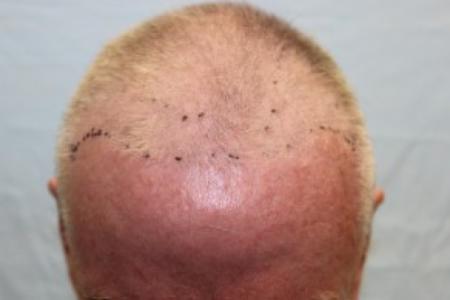 Before Case #87386 - Hair Transplantation San Diego