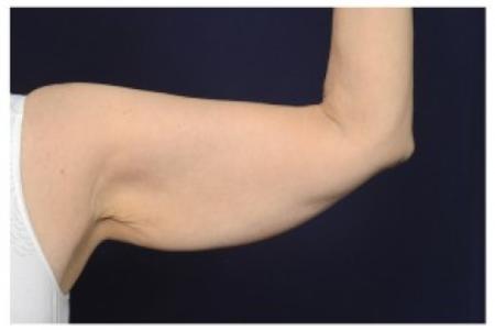 Before image 1 Case #86991 - Upper Arm Lift