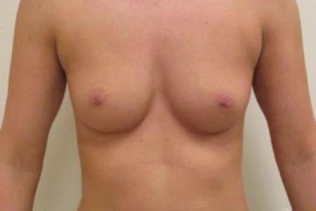 Before image 1 Case #82656 - Breast Augmentation (32 year old)
