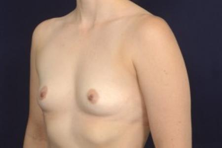 Before image 2 Case #87526 - Breast Augmentation
