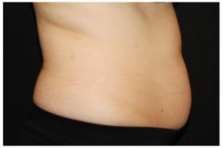 Before image 3 Case #86351 - 37 year old woman treated with nonsurgical fat reduction.