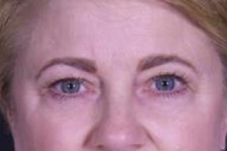 Before image 1 Case #84141 - Upper Eyelid Surgery