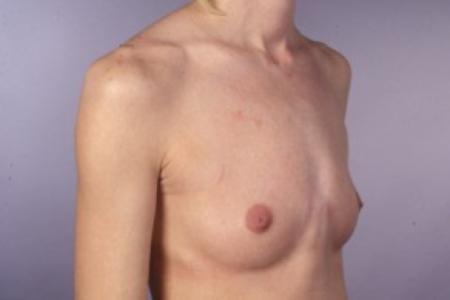 Before image 2 Case #83256 - Breast Augmentation with Saline Implants