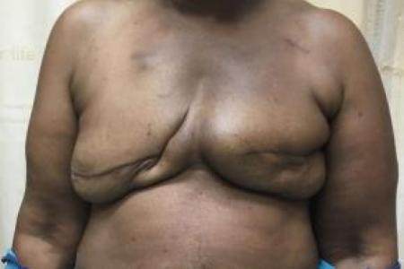 Before image 1 Case #88176 - Breast Reconstruction on a 63 year old patient